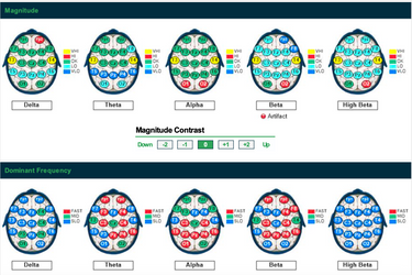 QEEG Deep Dive & Integration